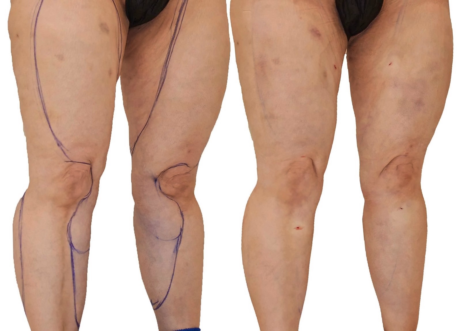 Before/After Lipedema liposuction before and after, actual patient of Dr. Long