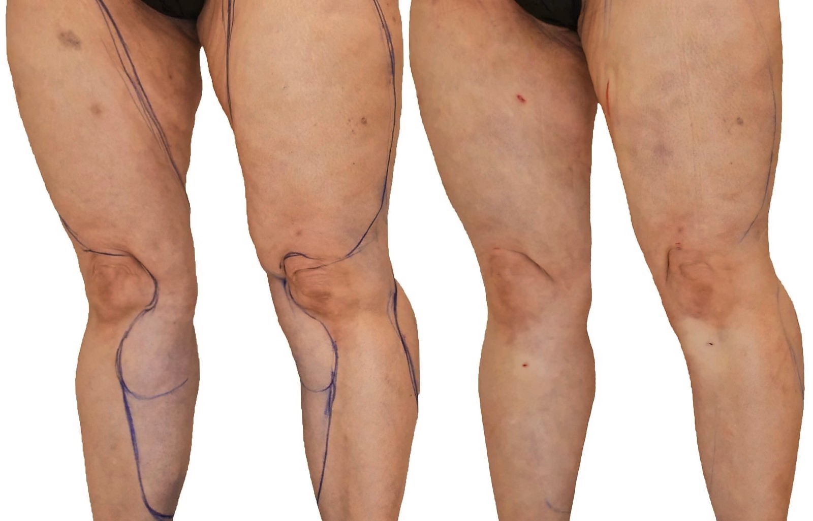 Before/After Lipedema liposuction before and after, actual patient of Dr. Long