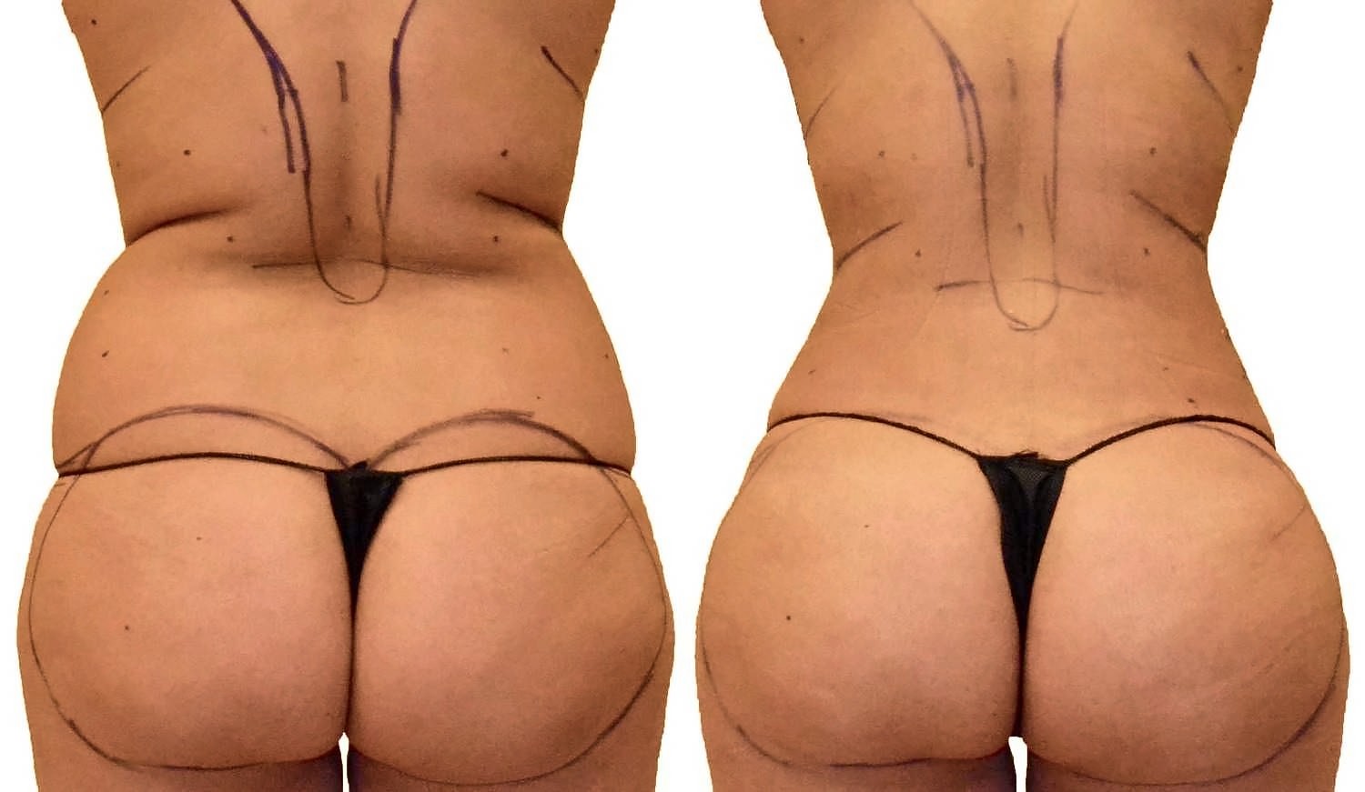 Before/After Lipo 360 before and after, actual patient of Dr. Long