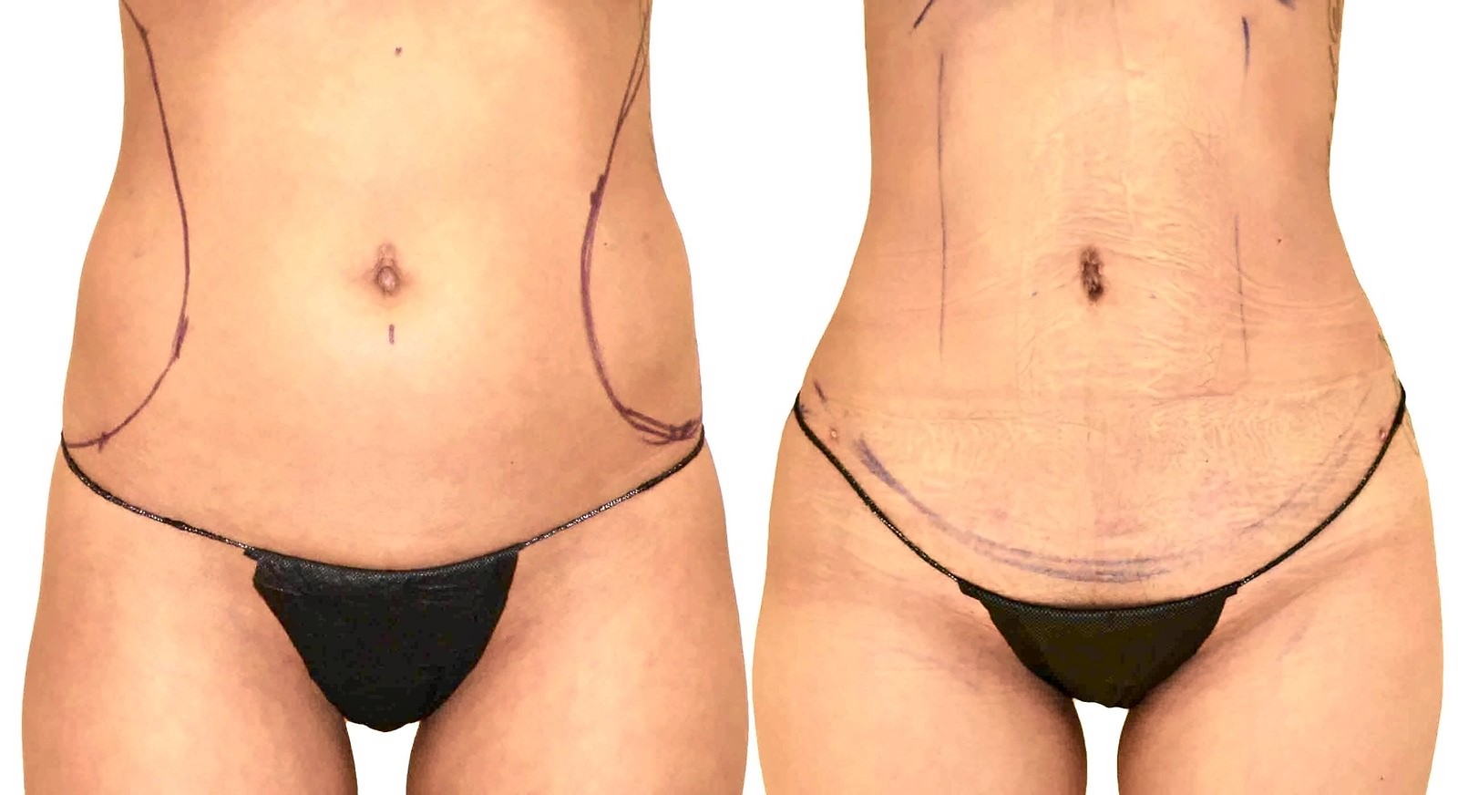 Before/After Lipo 360 before and after, actual patient of Dr. Long