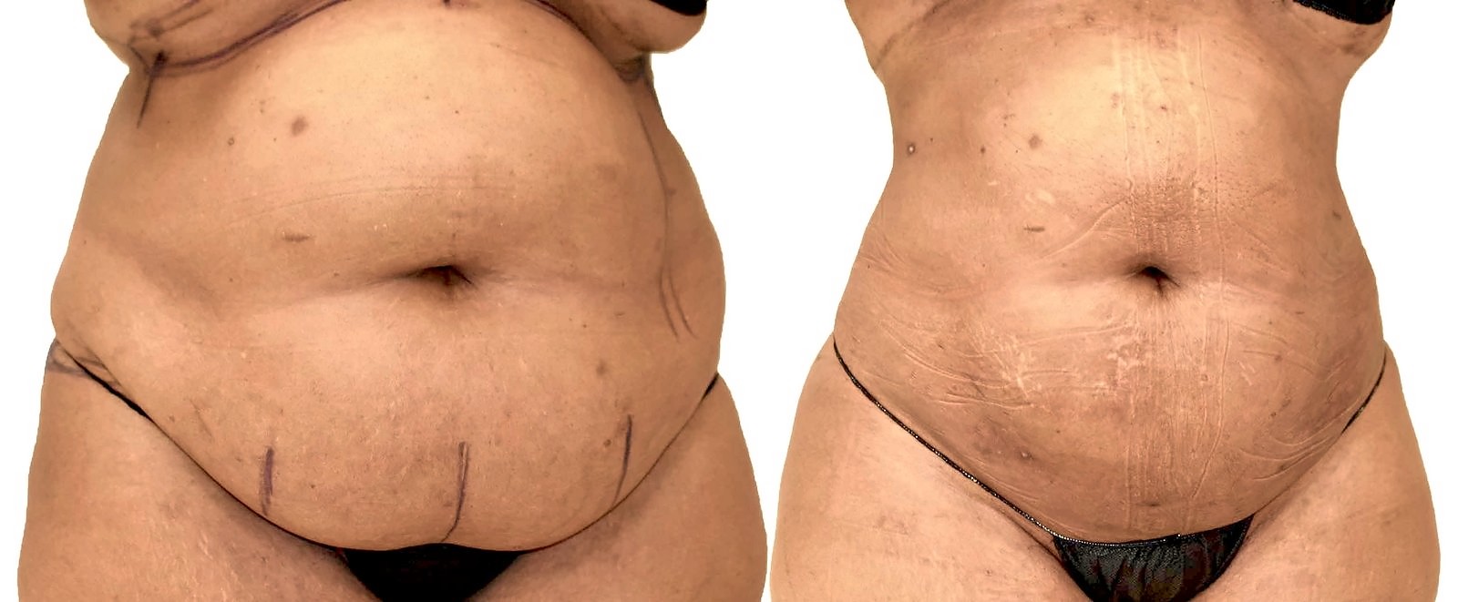 Before/After Lipo 360 before and after, actual patient of Dr. Long