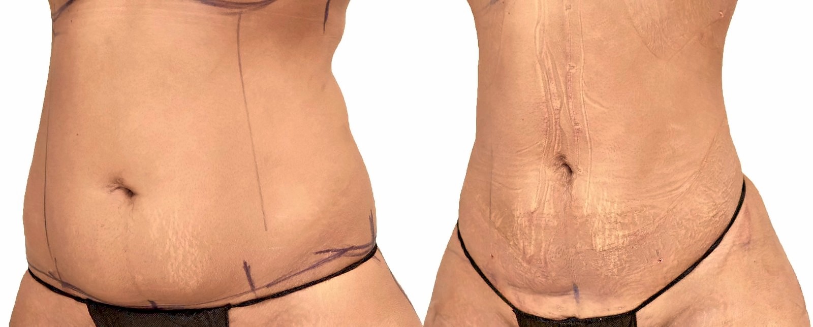 Before/After Lipo 360 before and after, actual patient of Dr. Long
