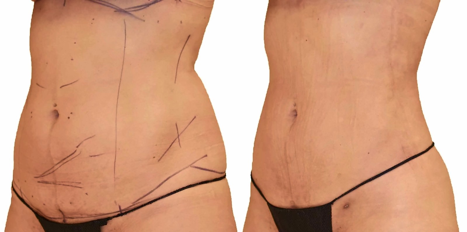 Before/After Lipo 360 before and after, actual patient of Dr. Long