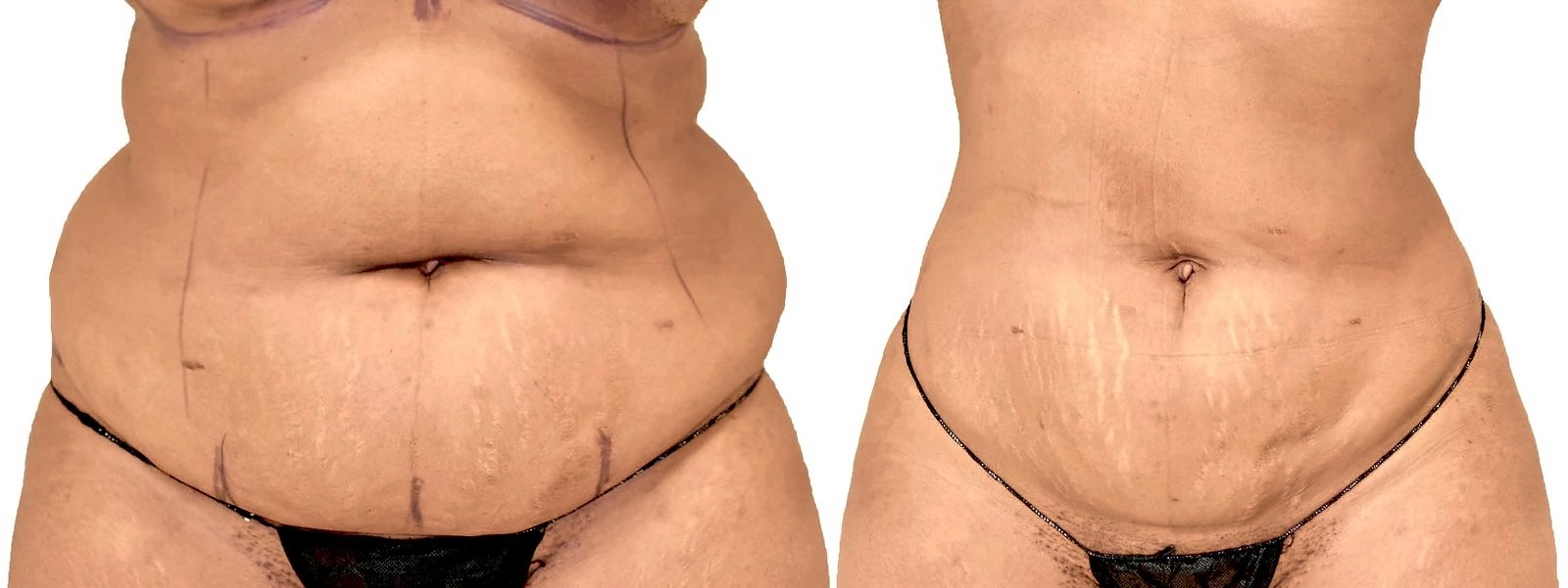 Before/After Lipo 360 before and after, actual patient of Dr. Long