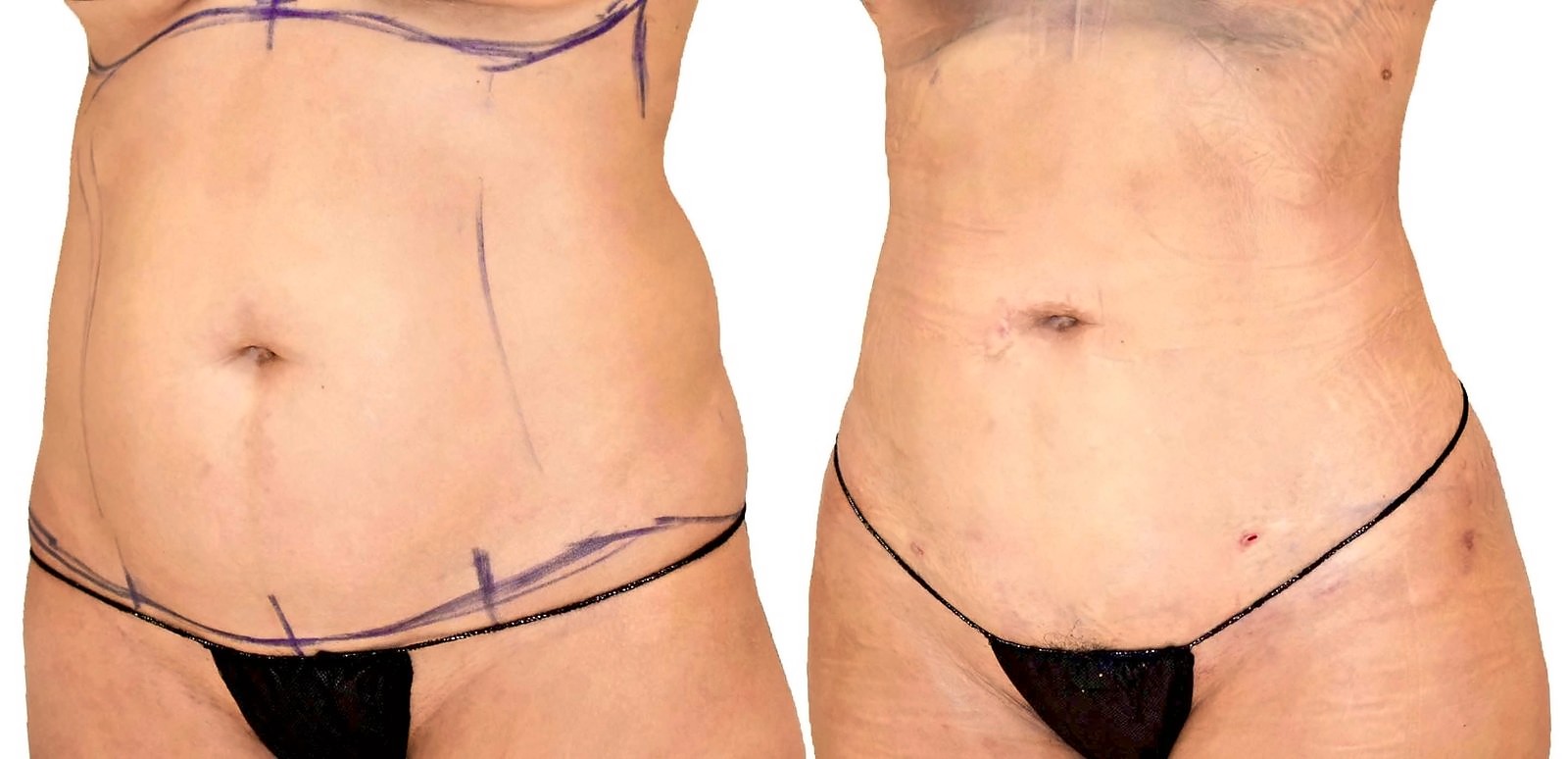 Before/After Lipo 360 before and after, actual patient of Dr. Long