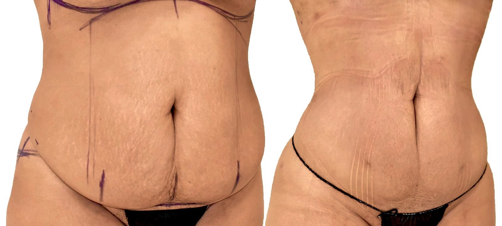 Before/After Lipo 360 before and after, actual patient of Dr. Long