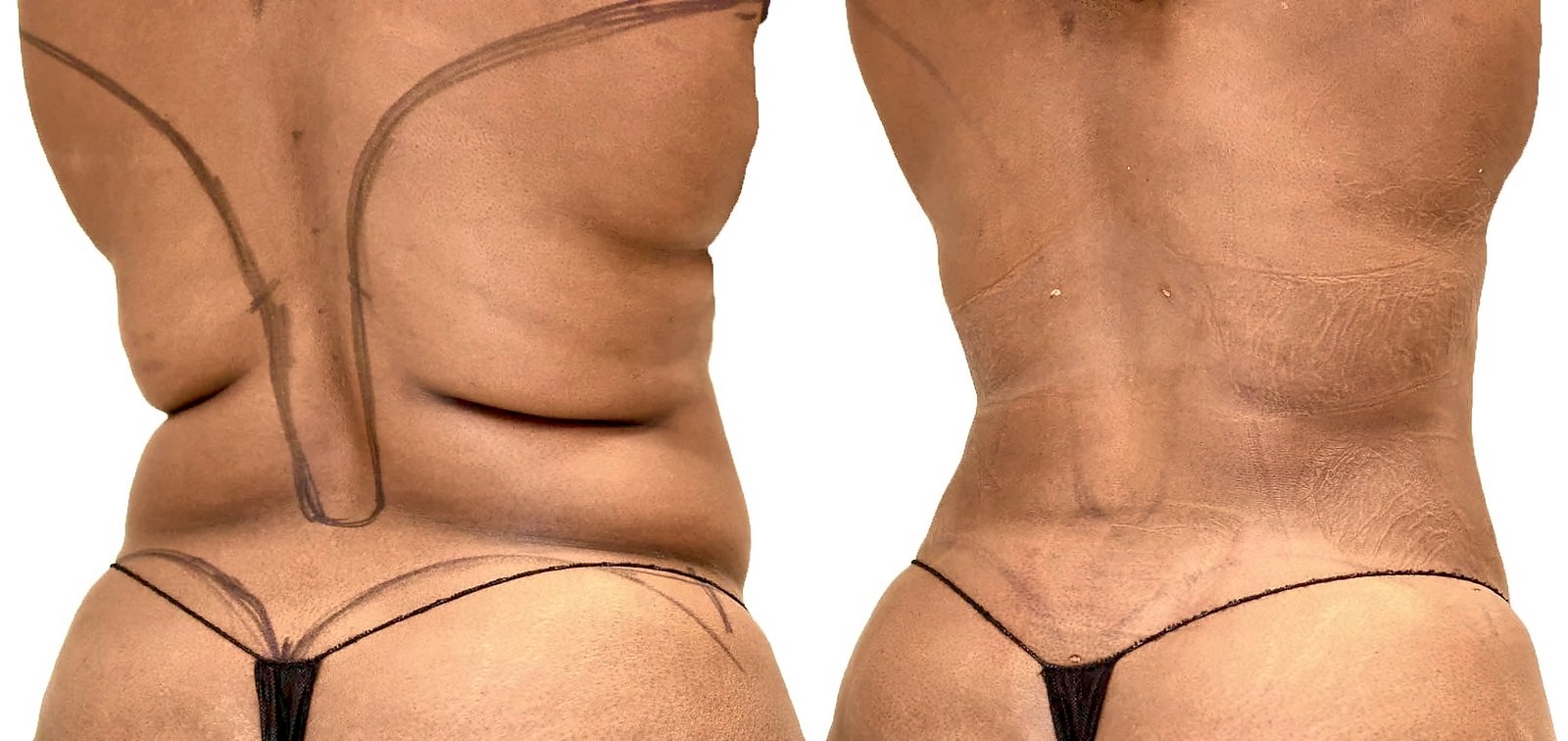 Before/After Lipo 360 before and after, actual patient of Dr. Long