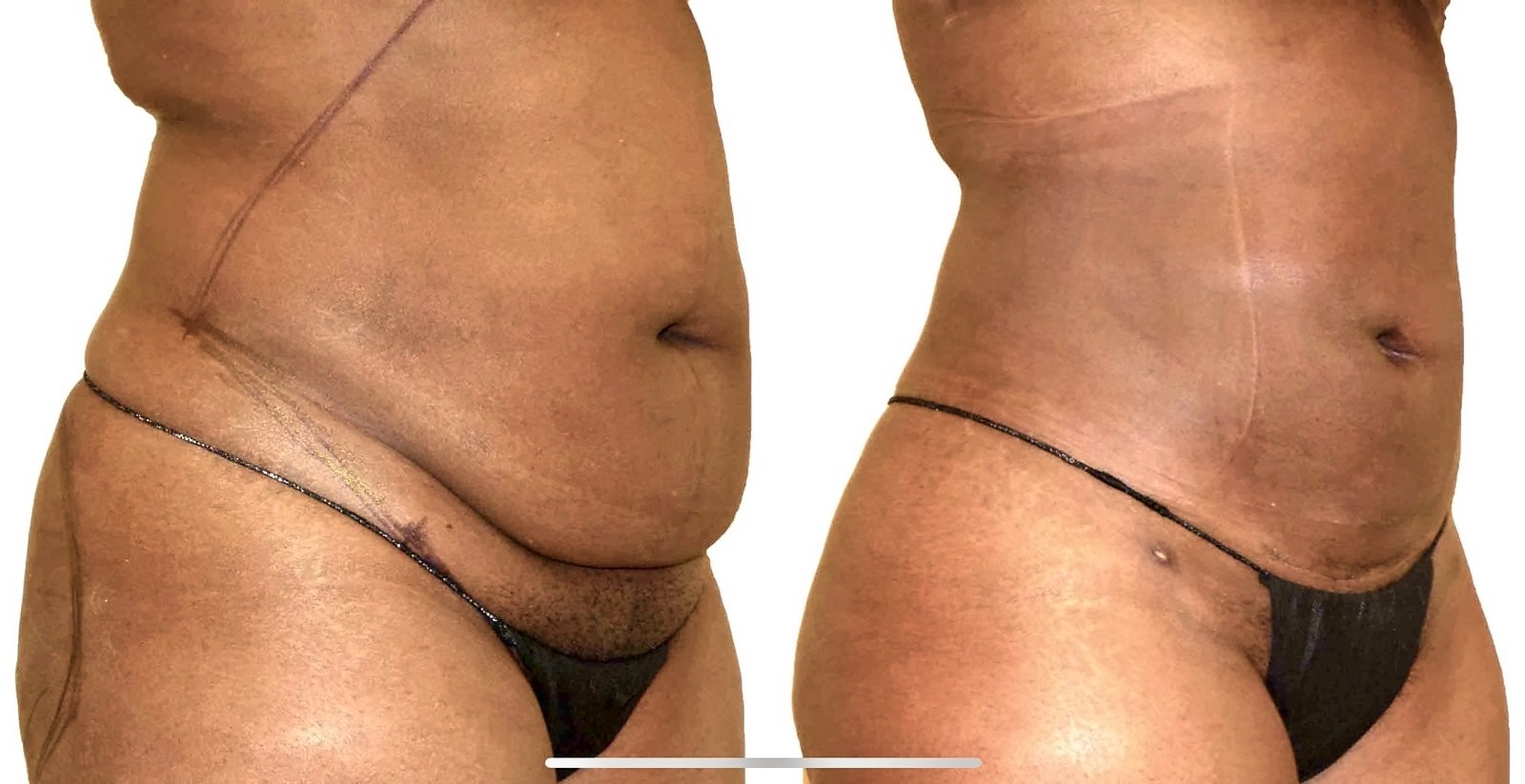Before/After Lipo 360 before and after, actual patient of Dr. Long