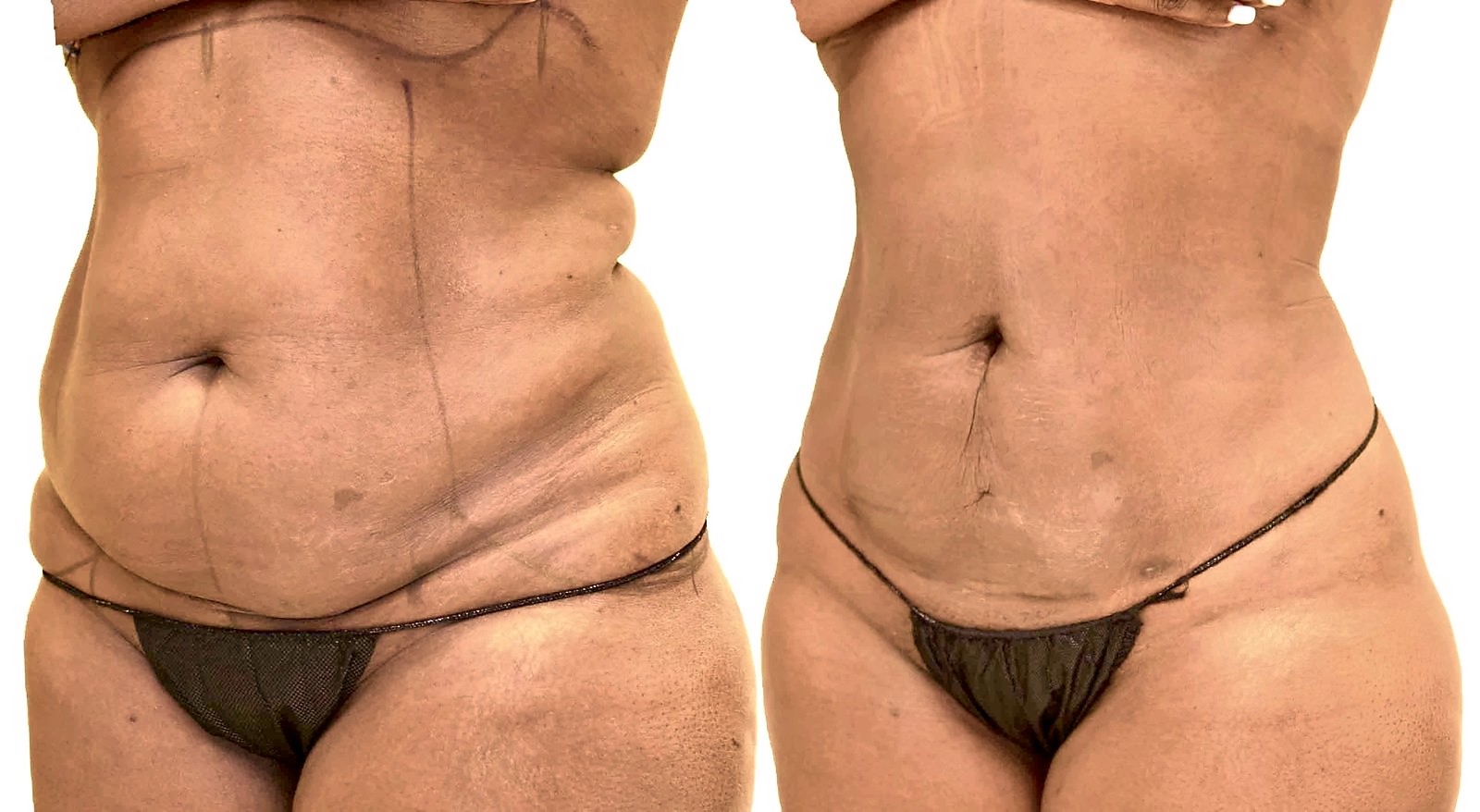 Before/After Lipo 360 before and after, actual patient of Dr. Long