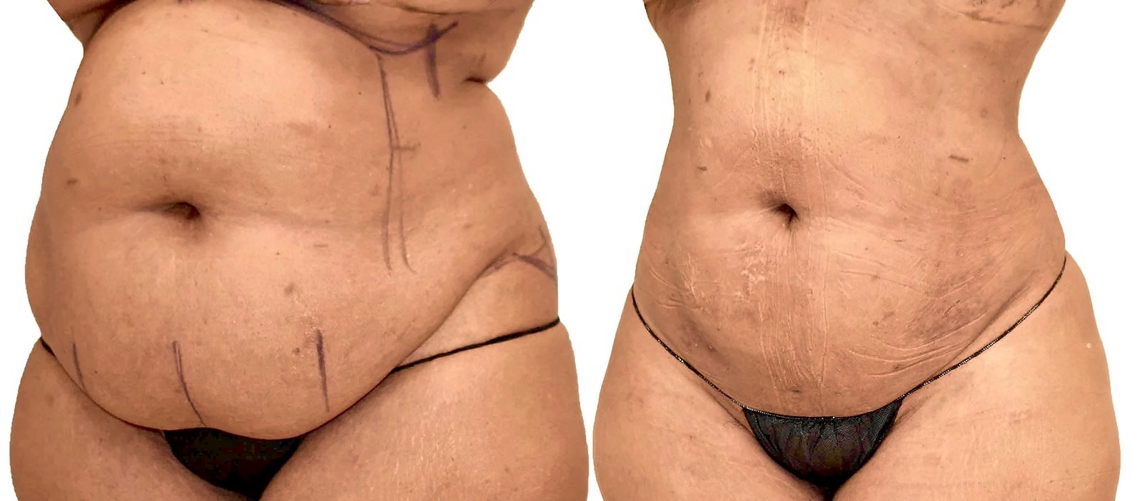 Before/After Lipo 360 before and after, actual patient of Dr. Long