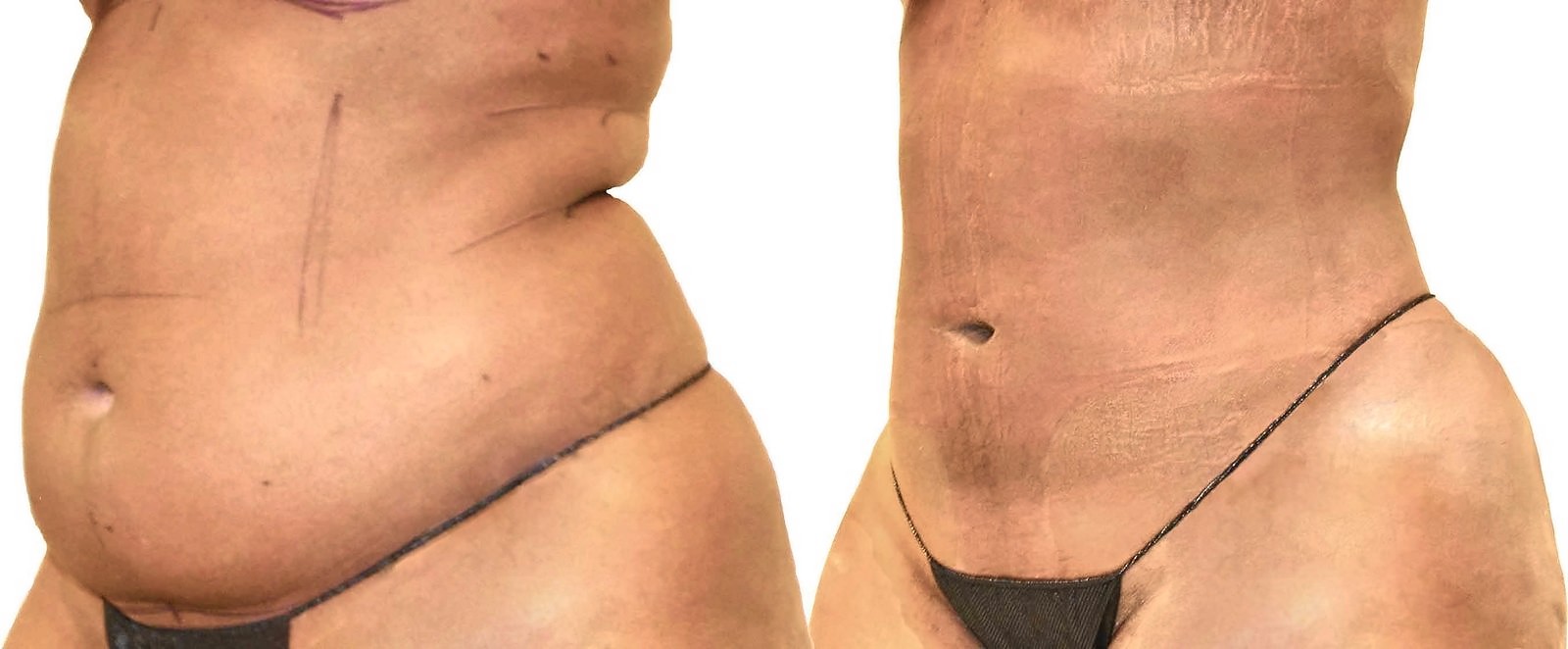 Before/After Lipo 360 before and after, actual patient of Dr. Long