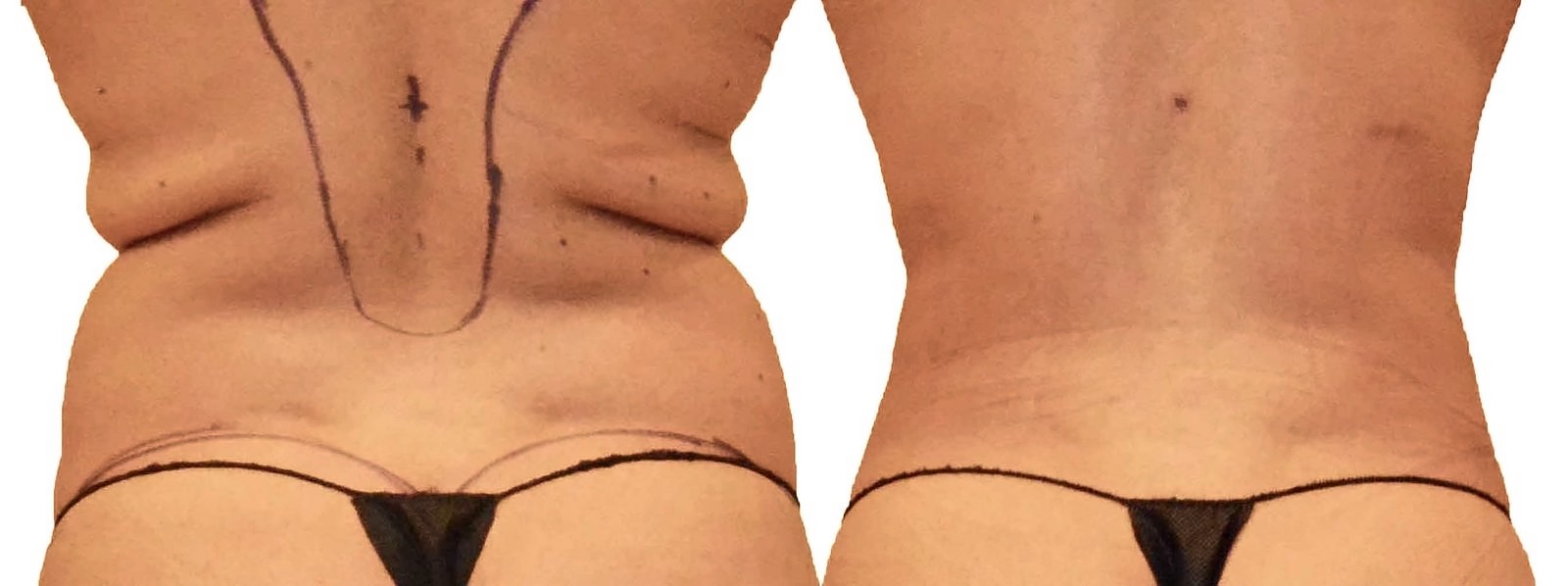 Before/After Lipo 360 before and after, actual patient of Dr. Long
