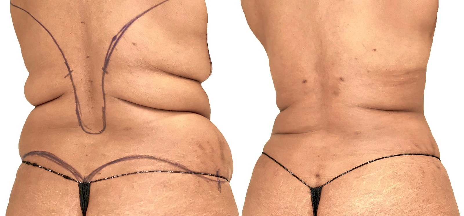 Before/After Lipo 360 before and after, actual patient of Dr. Long