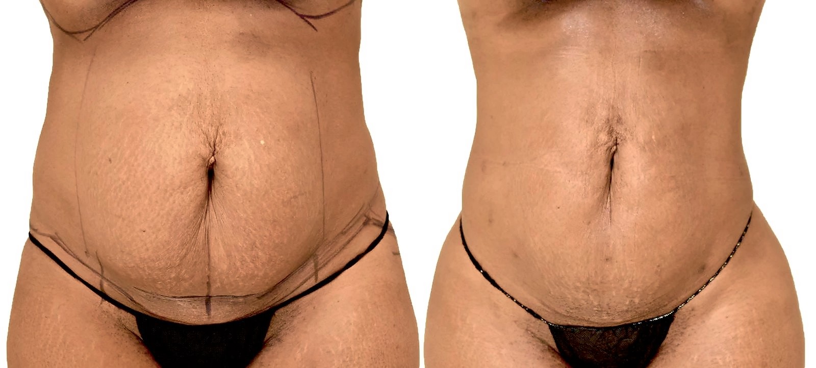Before/After Lipo 360 before and after, actual patient of Dr. Long