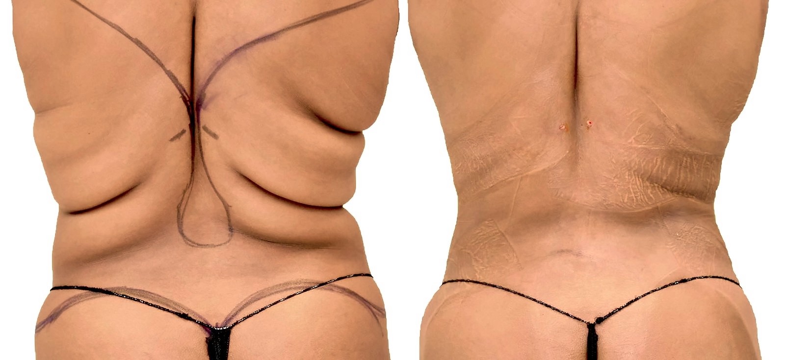 Before/After Lipo 360 before and after, actual patient of Dr. Long