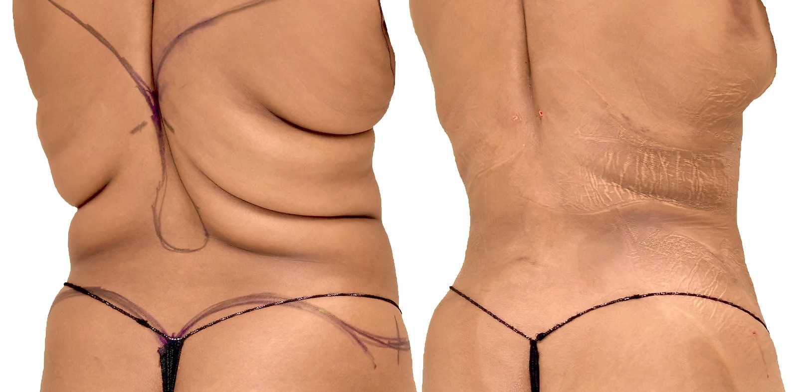 Before/After Lipo 360 before and after, actual patient of Dr. Long