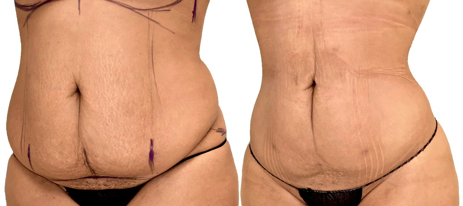 Before/After Lipo 360 before and after, actual patient of Dr. Long