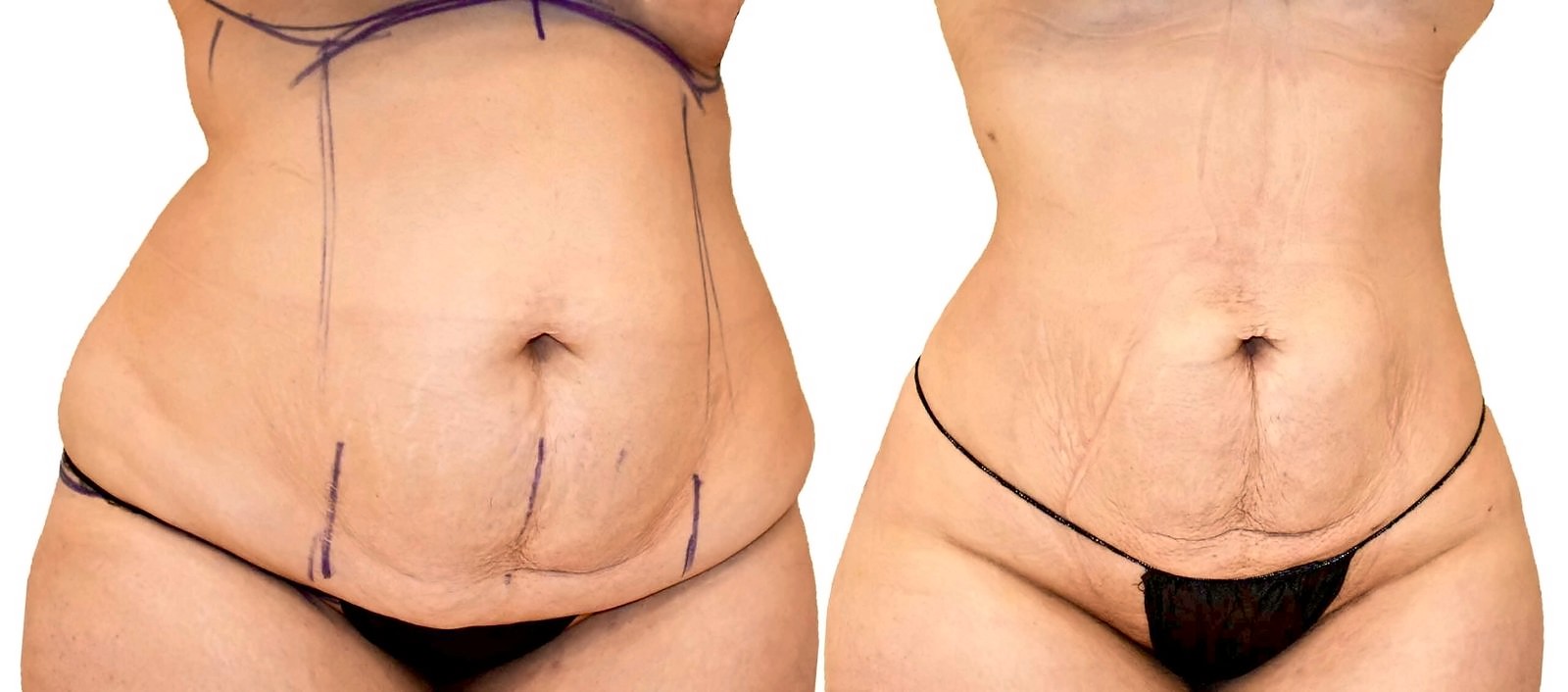 Before/After Lipo 360 before and after, actual patient of Dr. Long