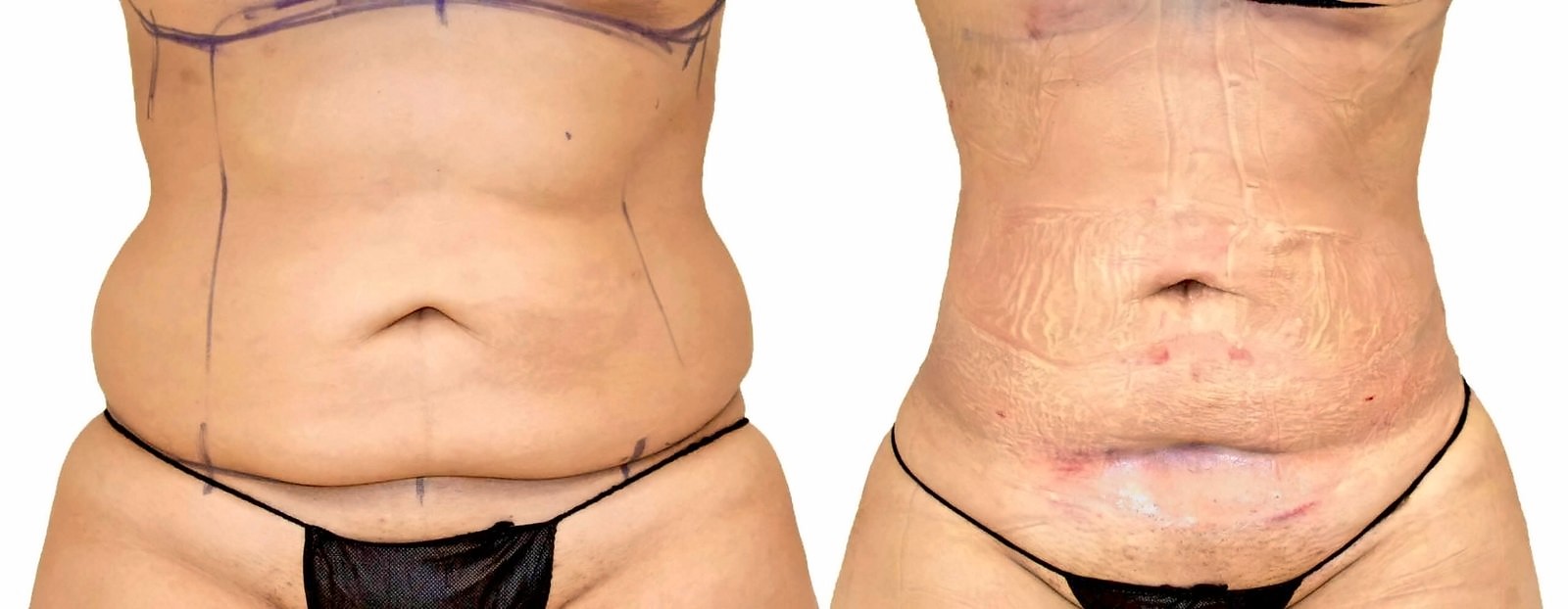 Before/After Lipo 360 before and after, actual patient of Dr. Long