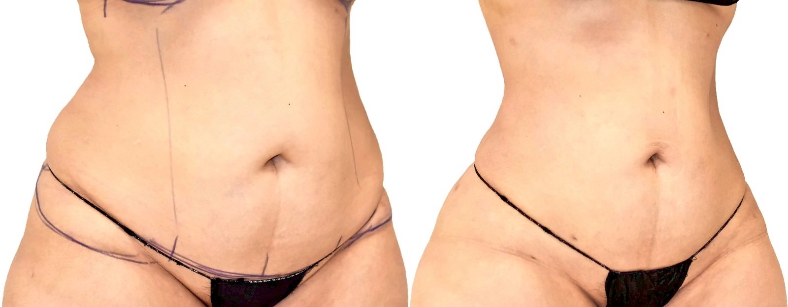 Before/After Lipo 360 before and after, actual patient of Dr. Long