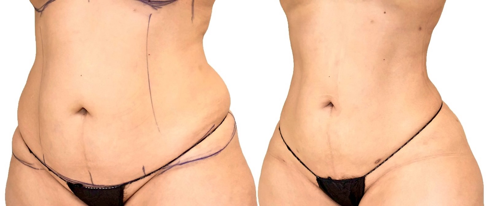 Before/After Lipo 360 before and after, actual patient of Dr. Long