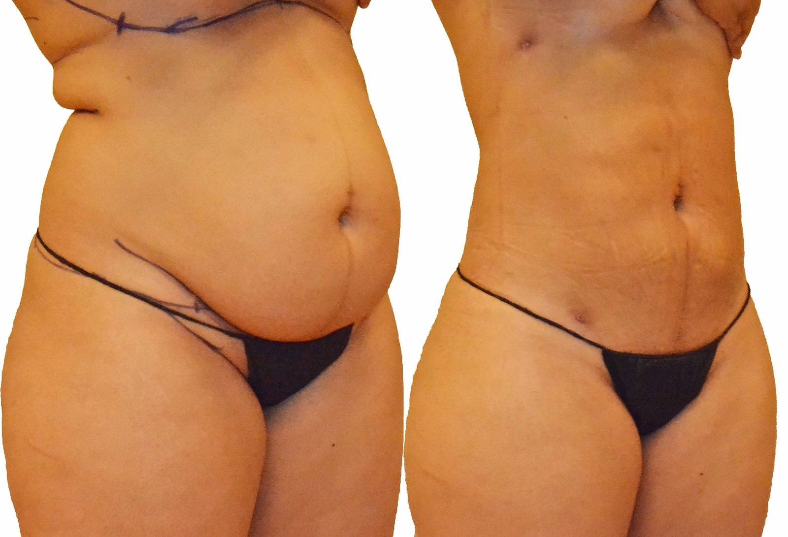 Before/After Lipo 360 before and after, actual patient of Dr. Long