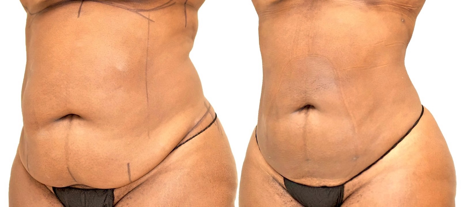Before/After Lipo 360 before and after, actual patient of Dr. Long
