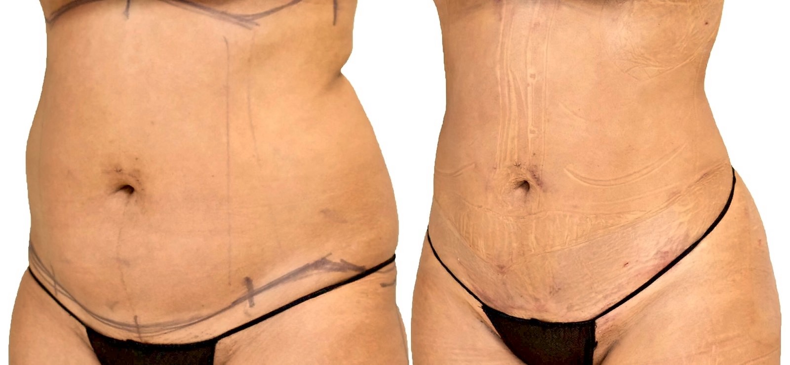Before/After Lipo 360 before and after, actual patient of Dr. Long