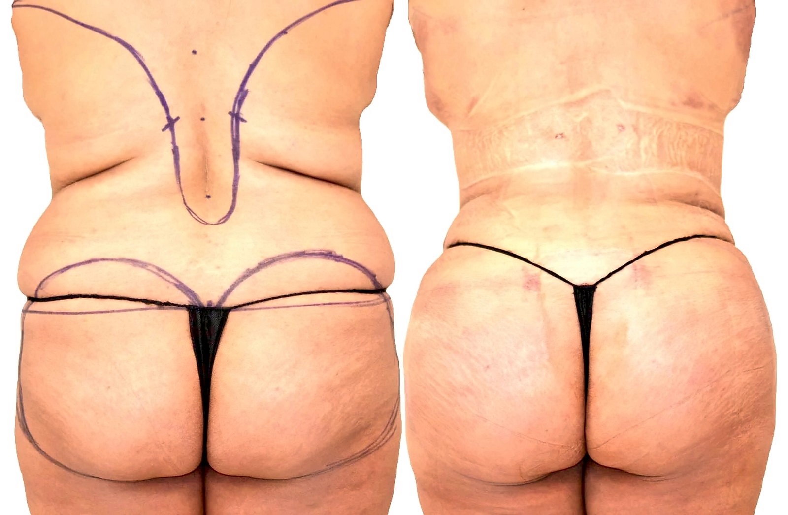 Before/After Lipo 360 before and after, actual patient of Dr. Long