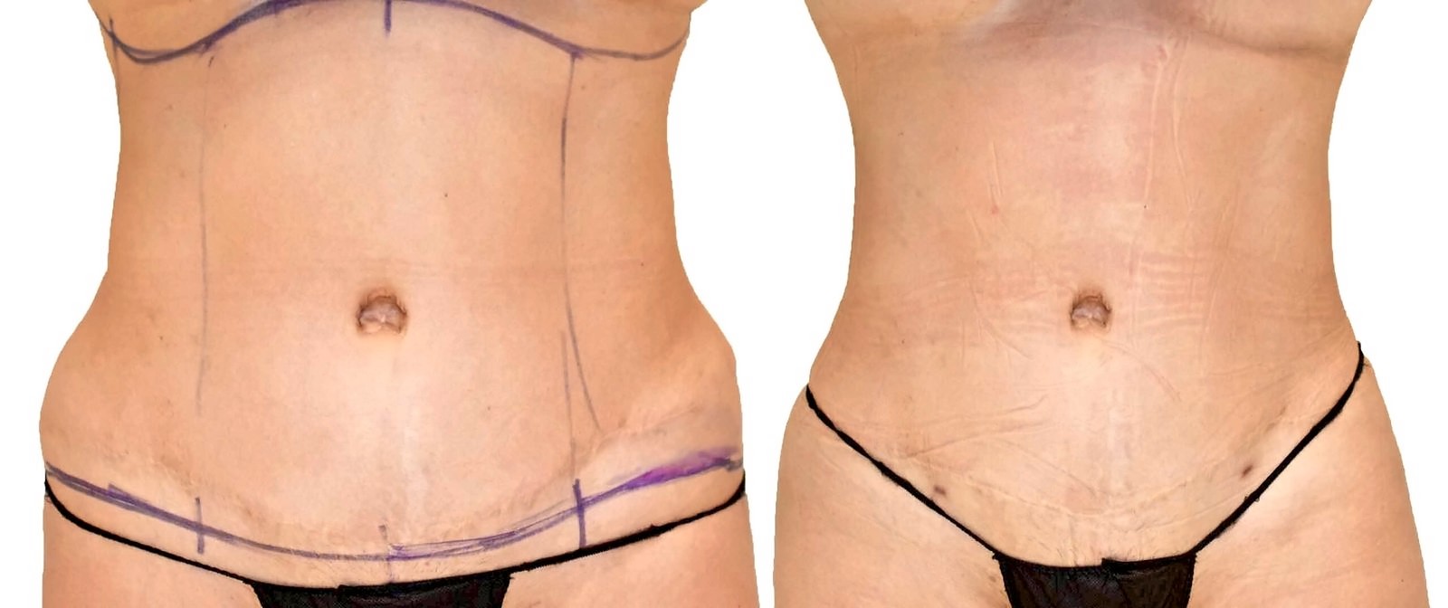 Before/After Lipo 360 before and after, actual patient of Dr. Long