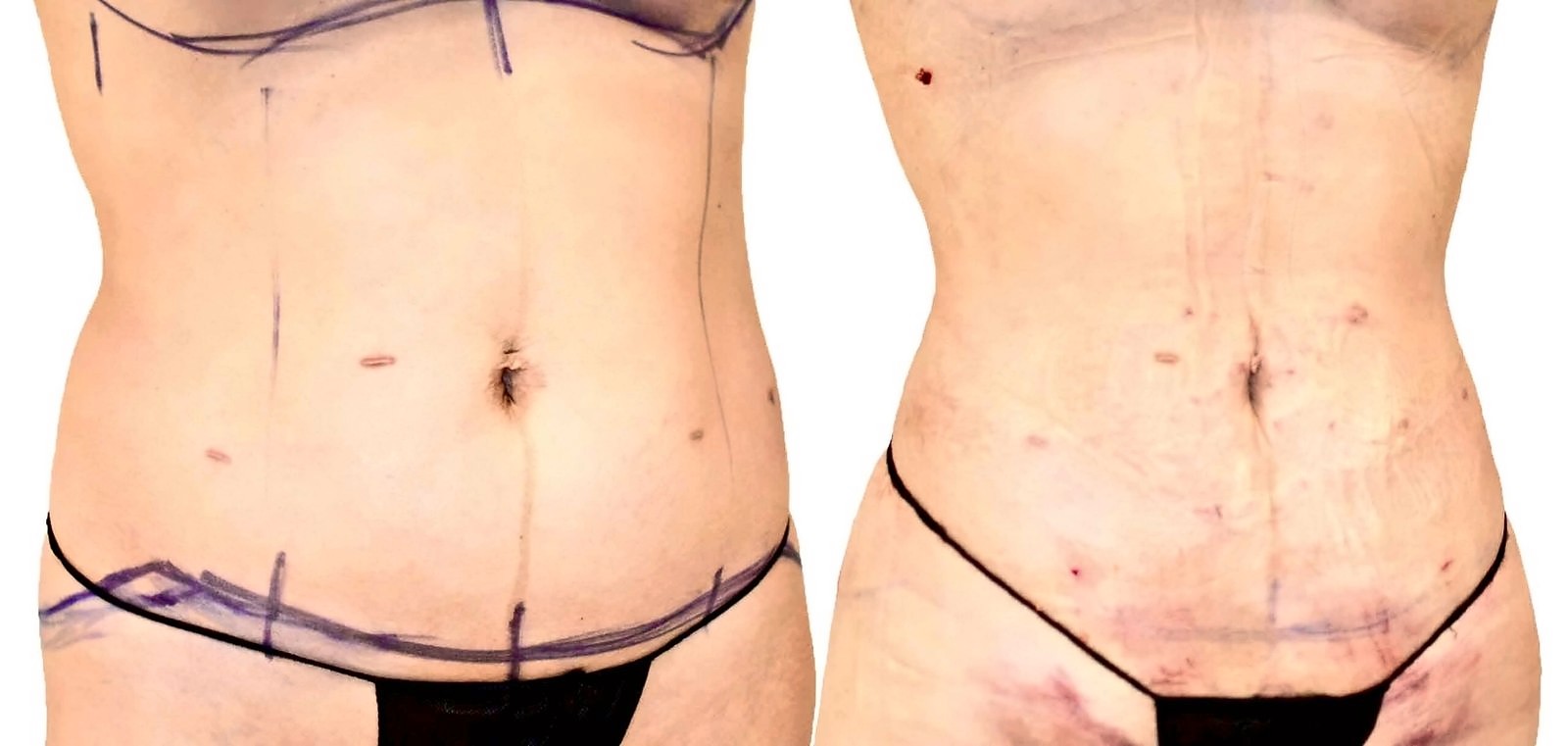 Before/After Lipo 360 before and after, actual patient of Dr. Long
