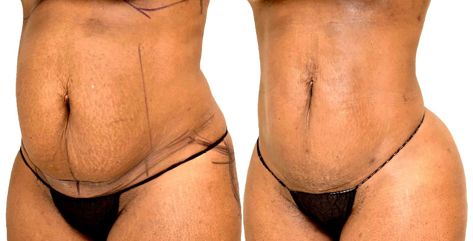 Before/After Lipo 360 before and after, actual patient of Dr. Long