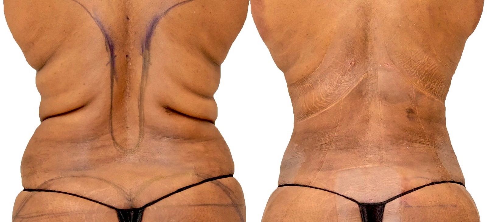Before/After Lipo 360 before and after, actual patient of Dr. Long