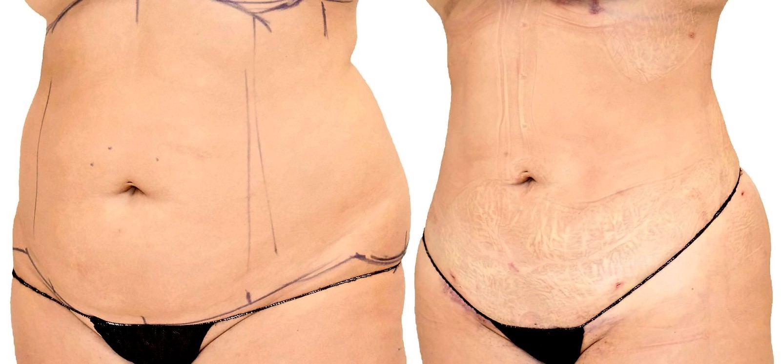 Before/After Lipo 360 before and after, actual patient of Dr. Long