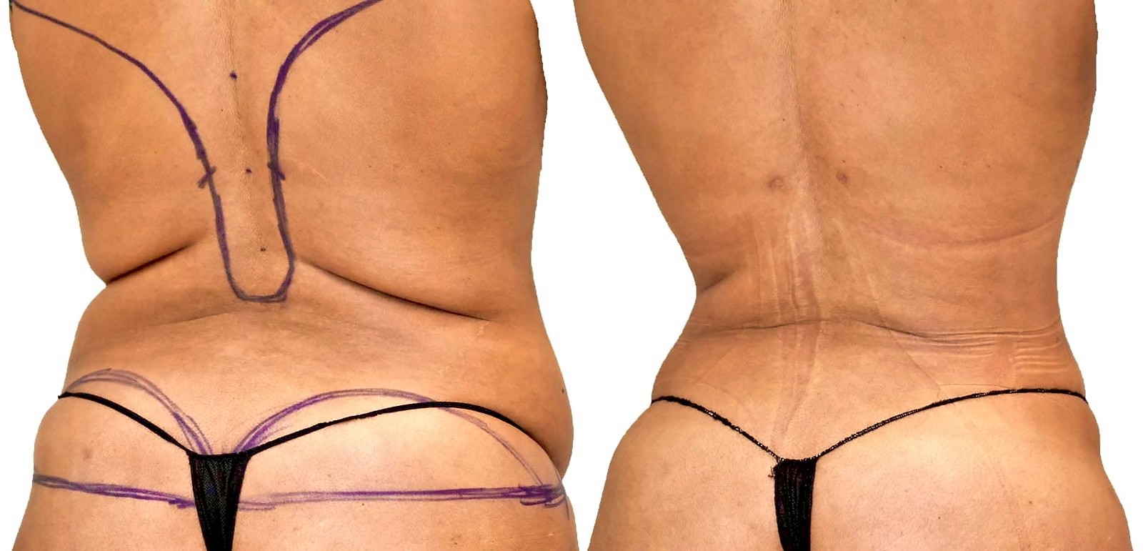Before/After Lipo 360 before and after, actual patient of Dr. Long