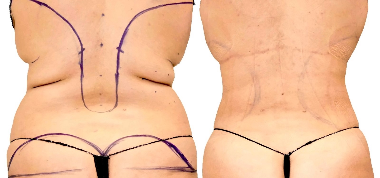 Before/After Lipo 360 before and after, actual patient of Dr. Long