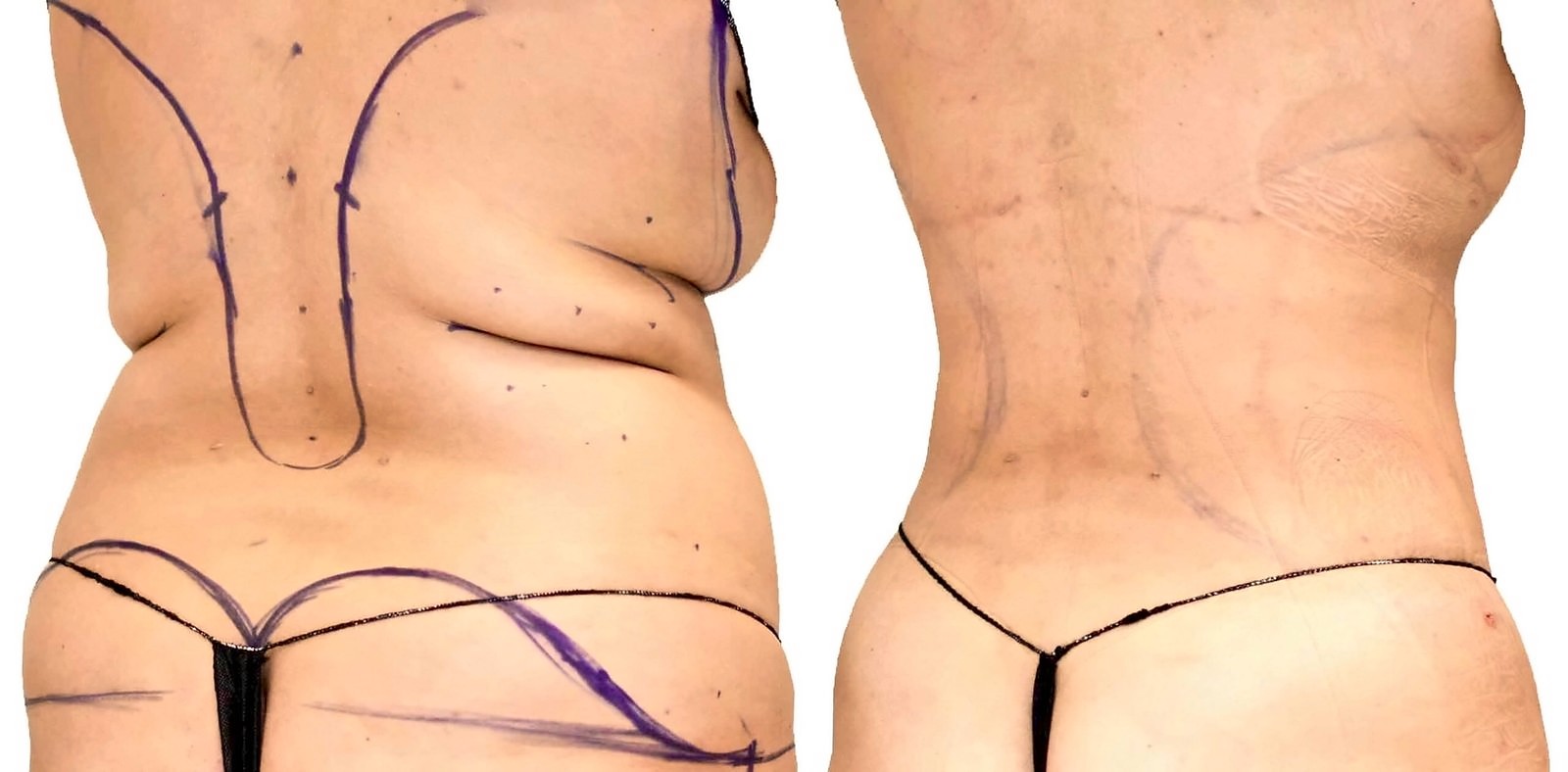 Before/After Lipo 360 before and after, actual patient of Dr. Long
