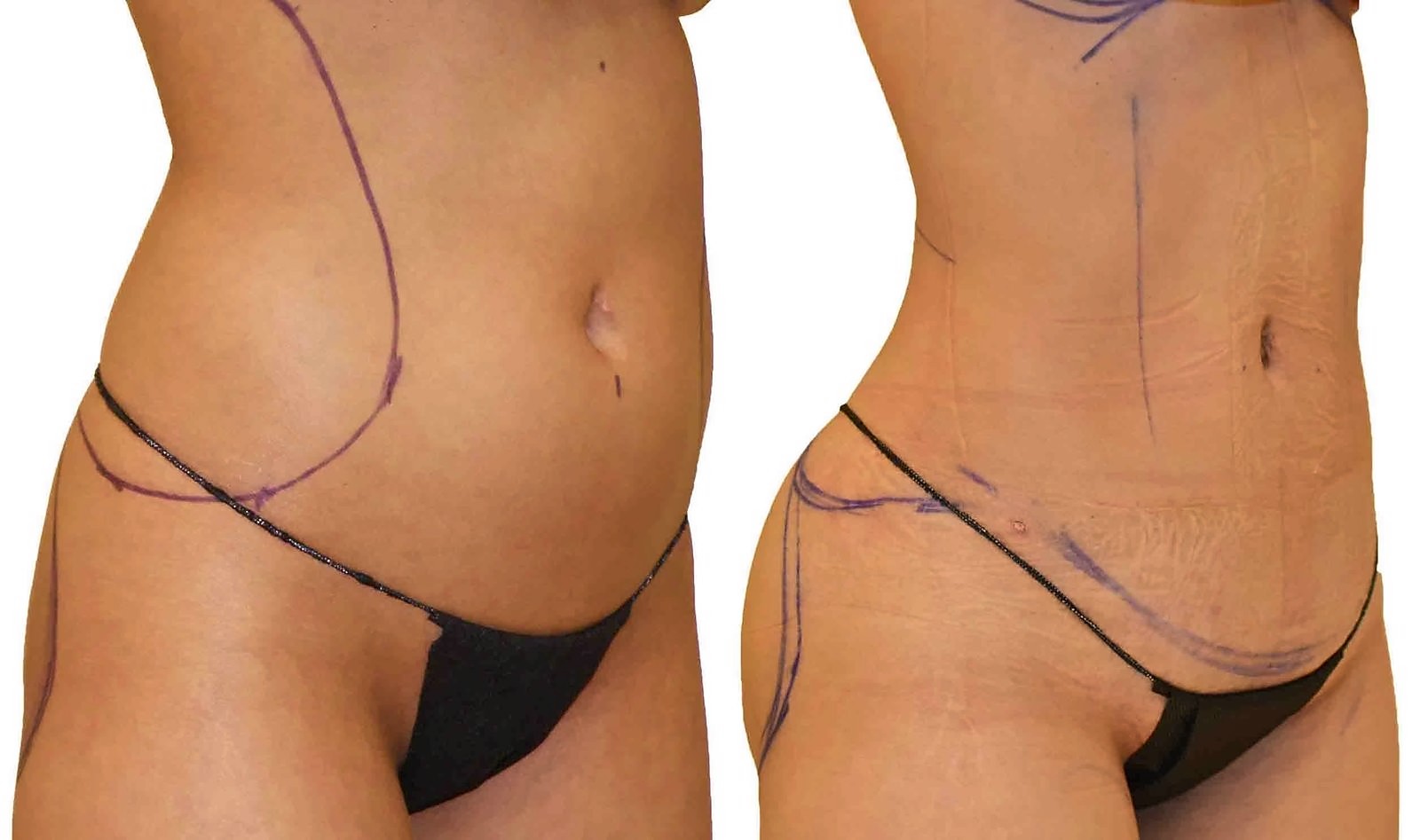 Before/After Lipo 360 before and after, actual patient of Dr. Long