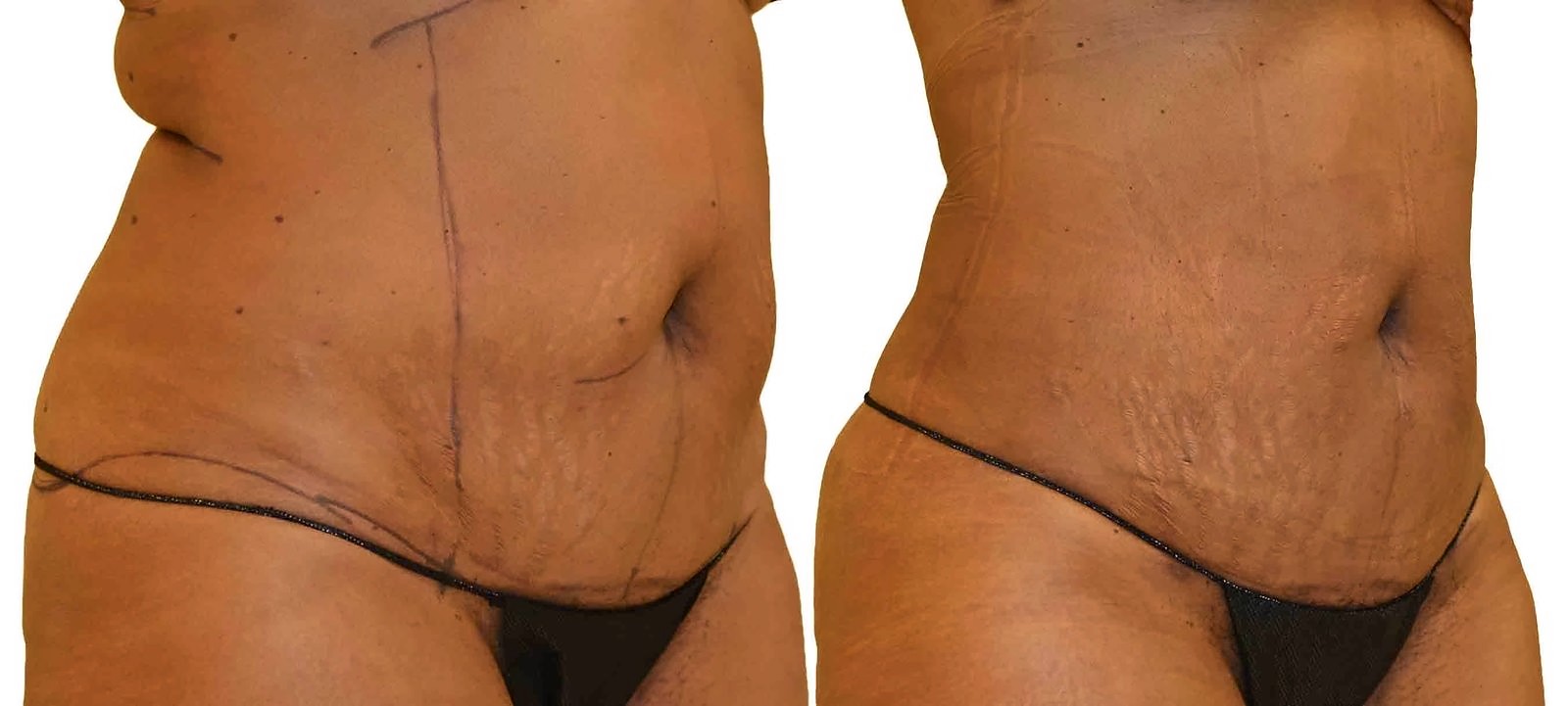 Before/After Lipo 360 before and after, actual patient of Dr. Long