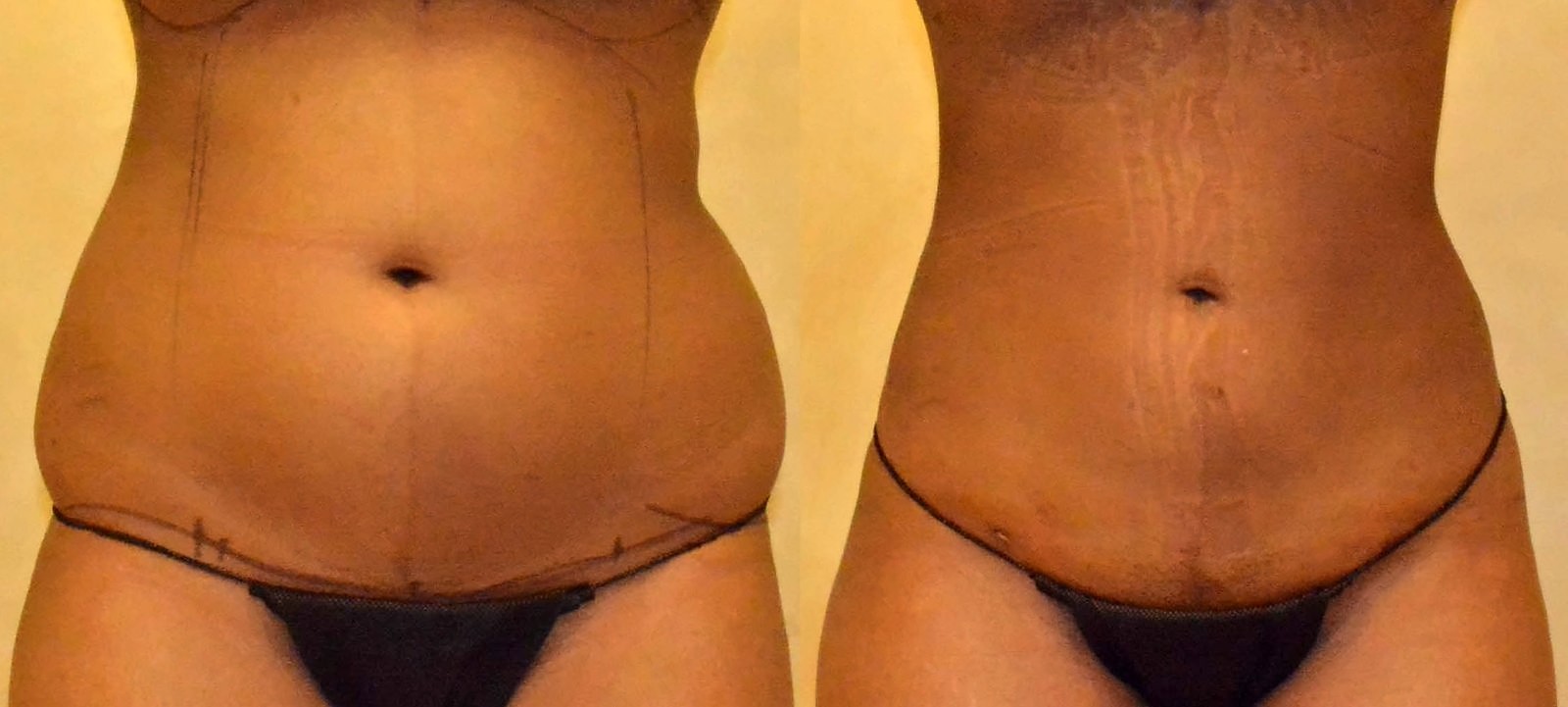 Before/After Lipo 360 before and after, actual patient of Dr. Long