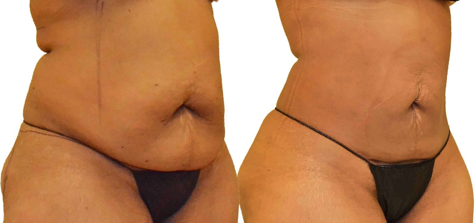 Before/After Lipo 360 before and after, actual patient of Dr. Long
