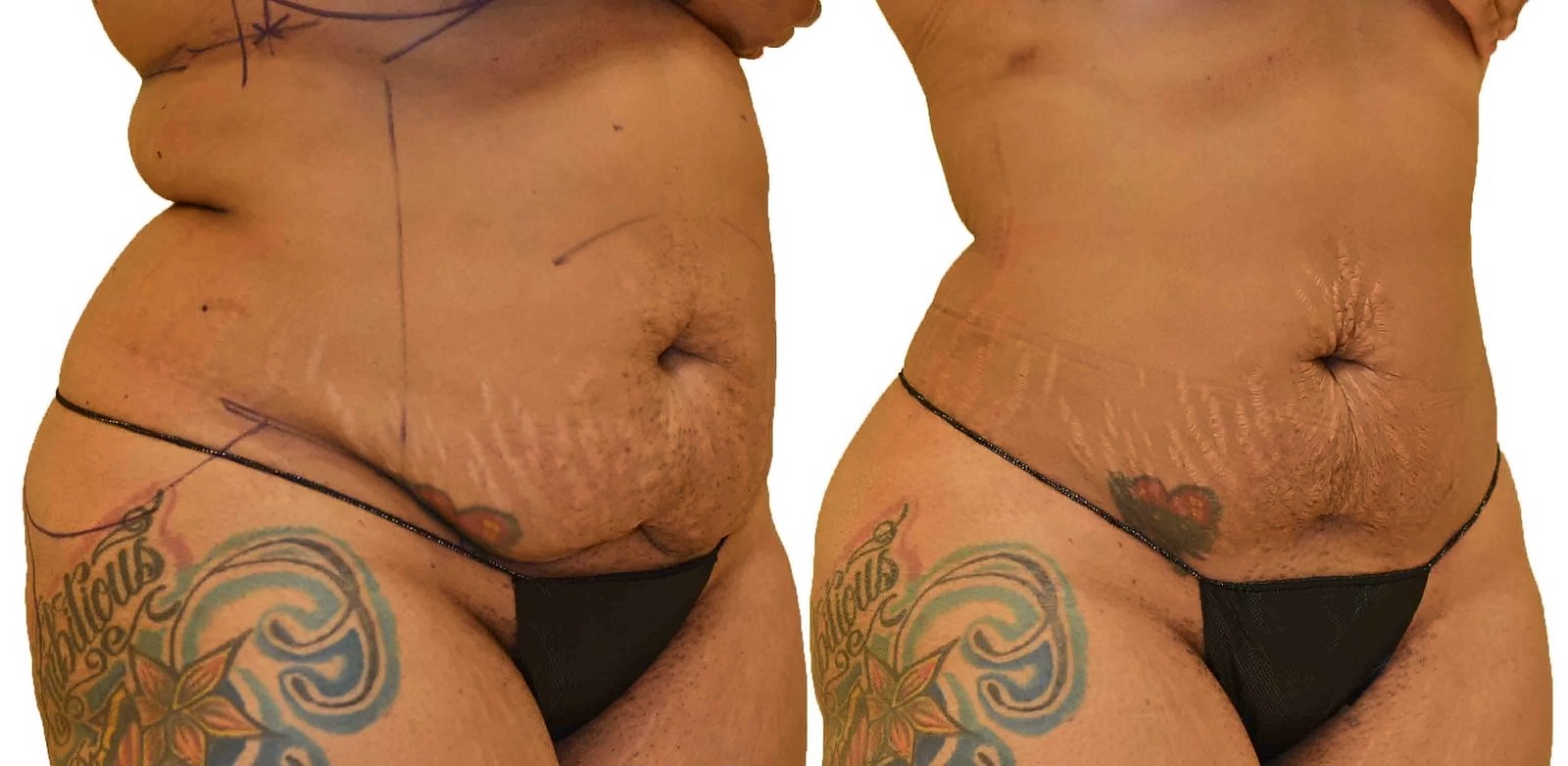 Before/After Lipo 360 before and after, actual patient of Dr. Long