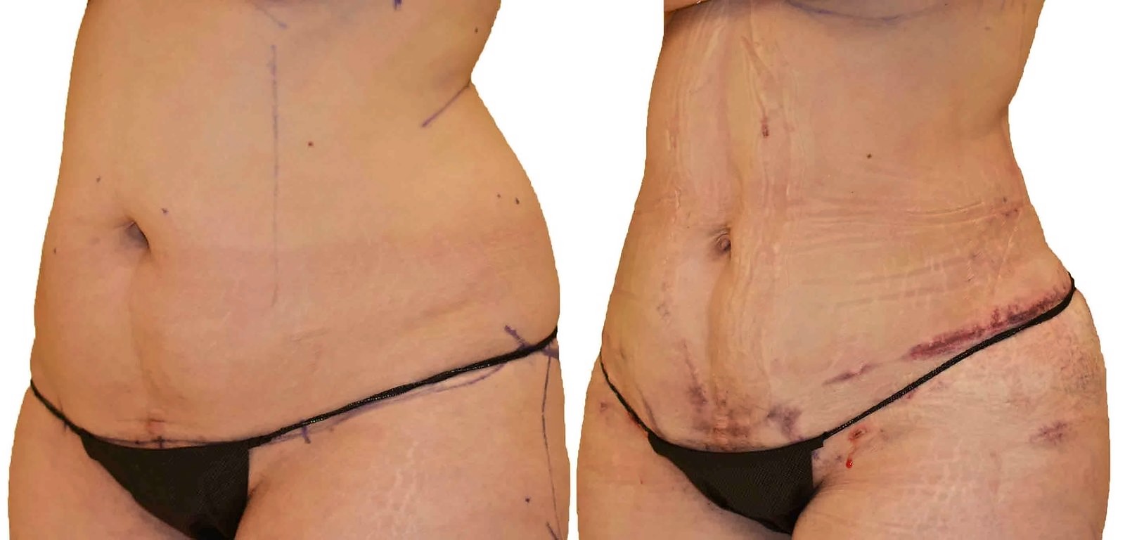 Before/After Lipo 360 before and after, actual patient of Dr. Long