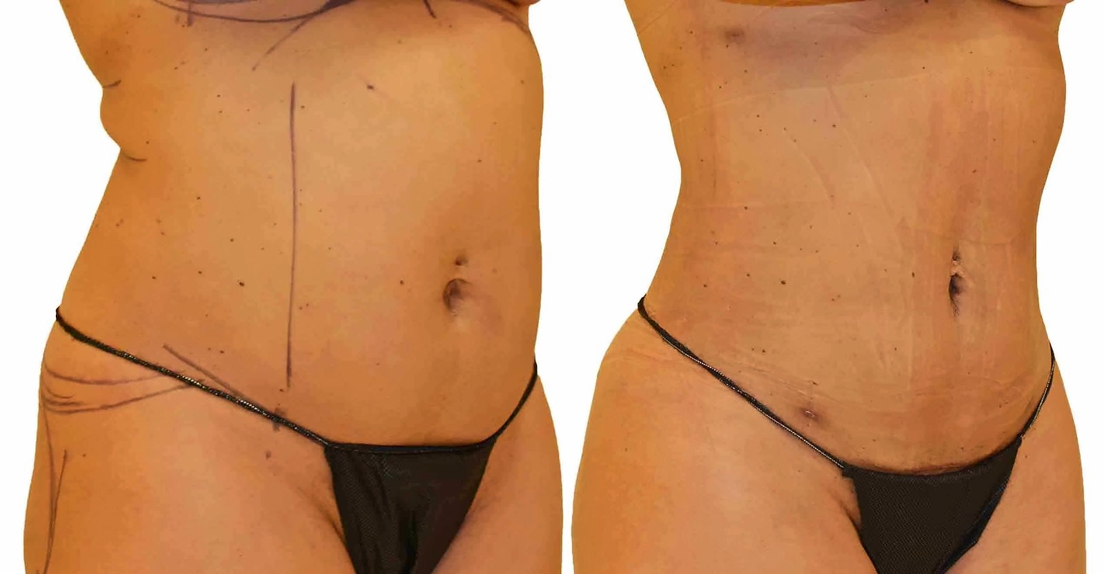 Before/After Lipo 360 before and after, actual patient of Dr. Long