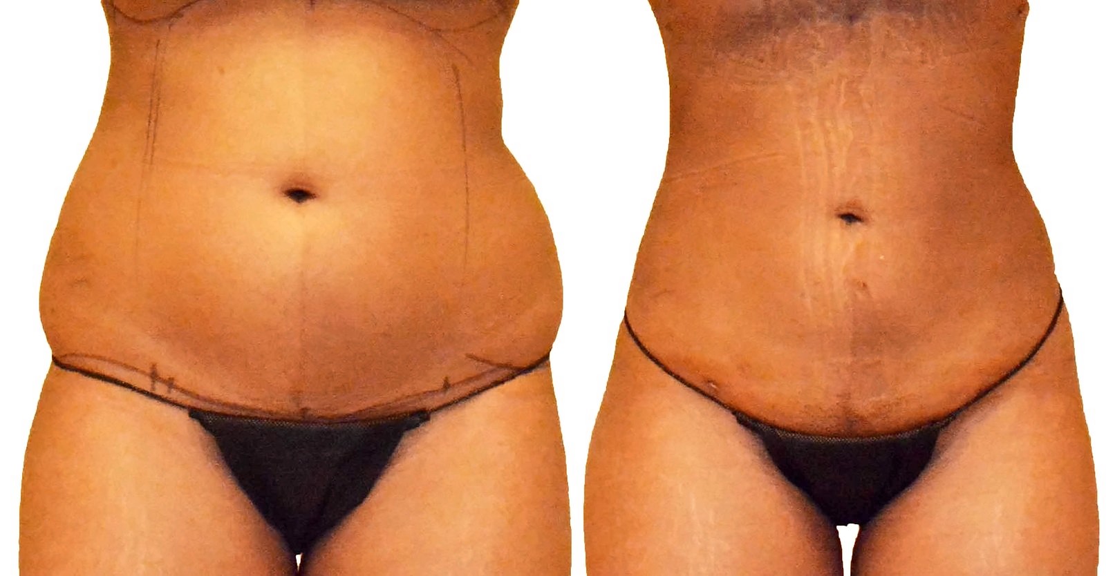 Before/After Lipo 360 before and after, actual patient of Dr. Long