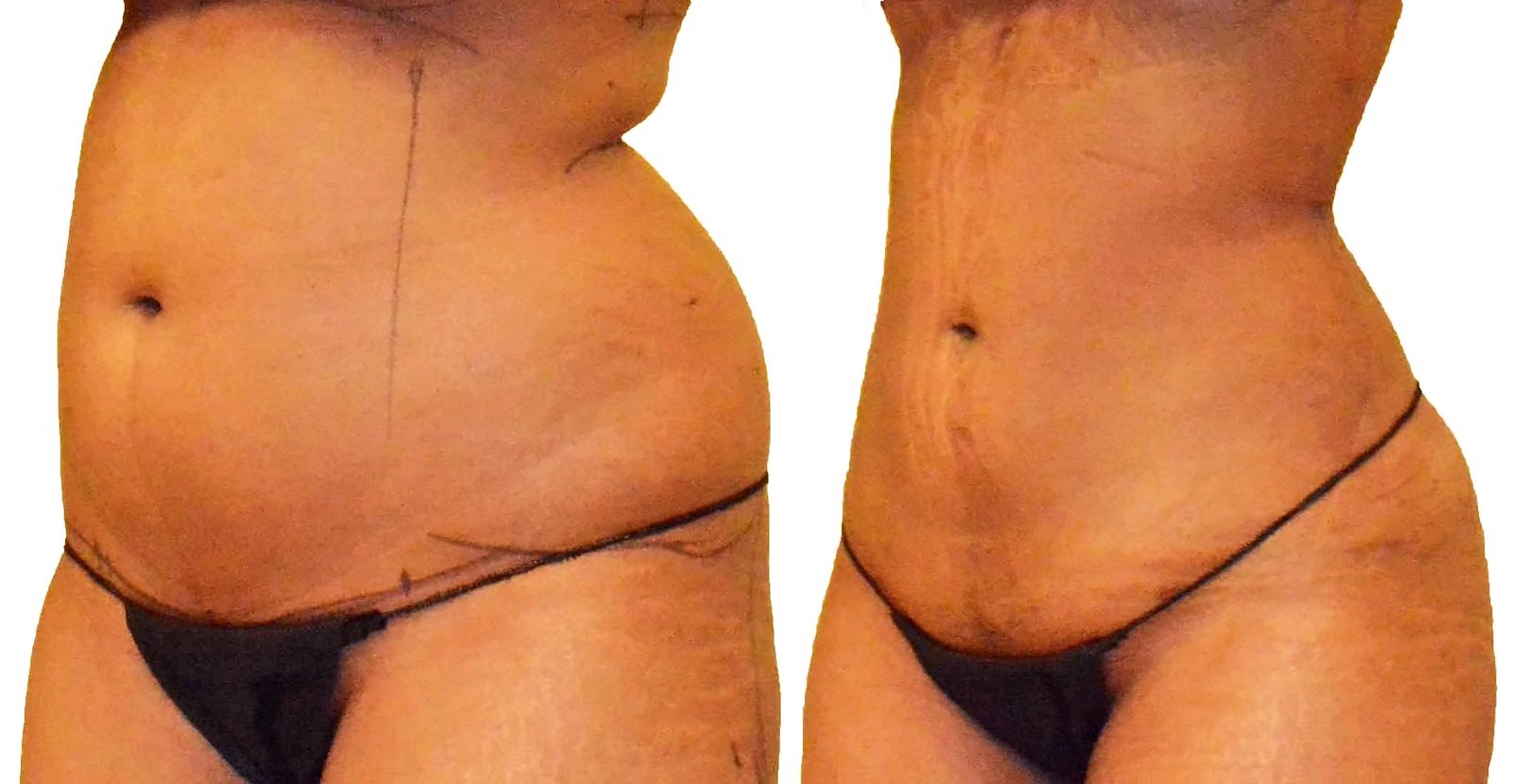 Before/After Lipo 360 before and after, actual patient of Dr. Long