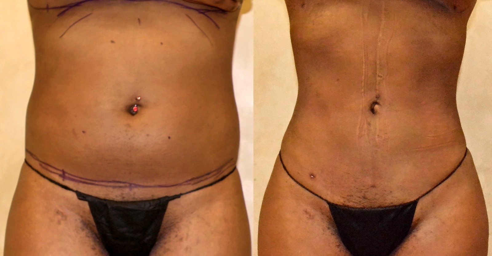 Before/After Lipo 360 before and after, actual patient of Dr. Long