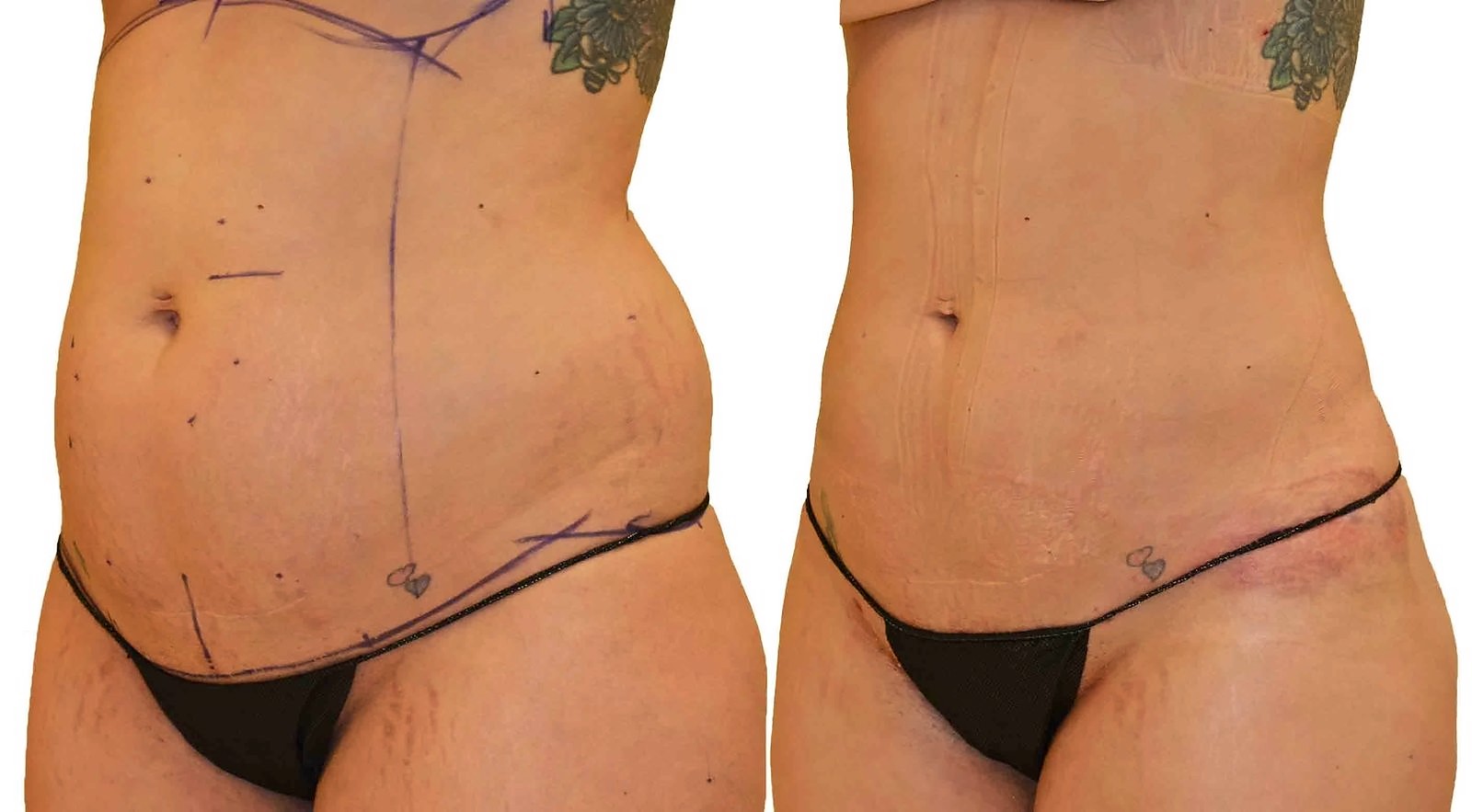 Before/After Lipo 360 before and after, actual patient of Dr. Long
