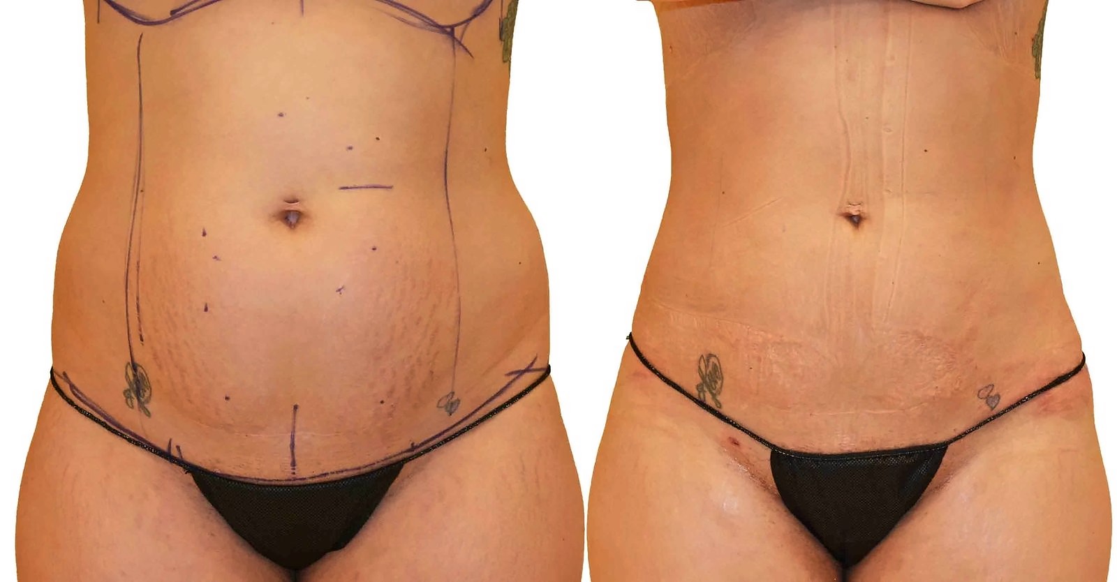 Before/After Lipo 360 before and after, actual patient of Dr. Long