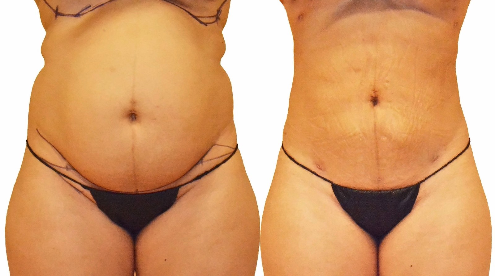 Before/After Lipo 360 before and after, actual patient of Dr. Long